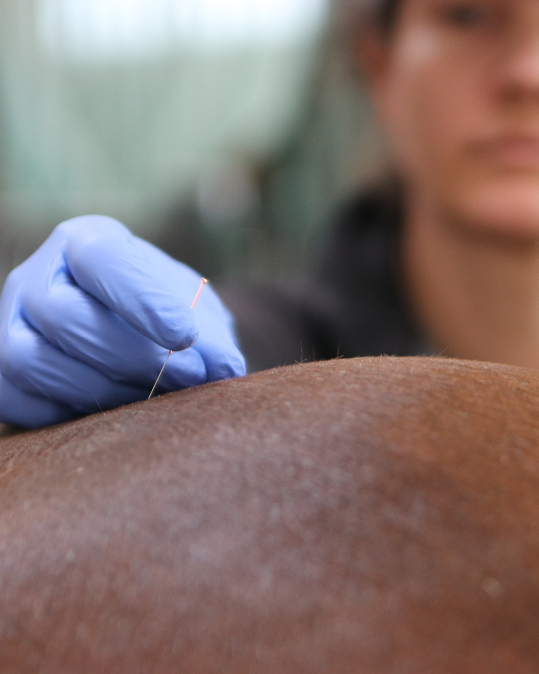 Akupunktur beim Pferd - Nadel wird durch Tierärztin auf der Kruppe gesetzt